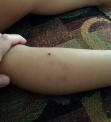 The unexplaned bite mark my child received while in the care of Carasoul Academy.