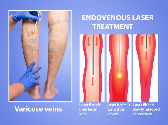 (EVLT) Endovenous Laser Treatment for varicose veins.