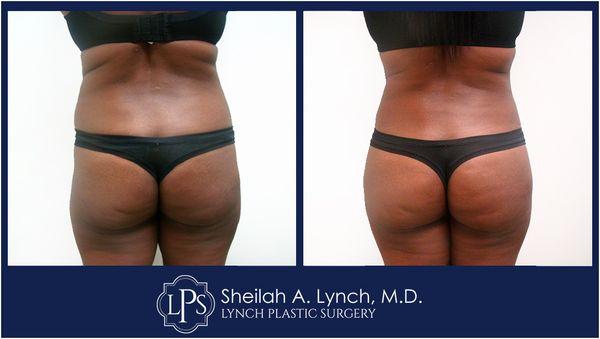 BBL Before & After Patient (Brazilian Butt Lift) Receive an expert opinion from Board Certified Plastic Surgeon  Dr. Sheilah A. Lynch.