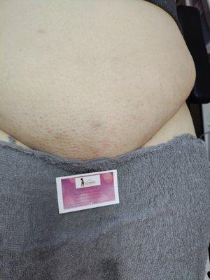 After photo of a full Brazilian wax and Vajacial