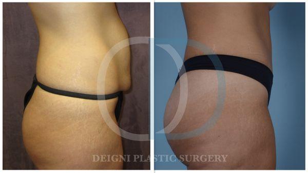 Tummy Tuck Profile View