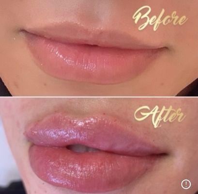 Lips filler with Juvederm ultra