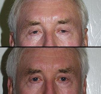 Patient received an eyelid lift to remove fat in the upper and lower portions of the eyelid.