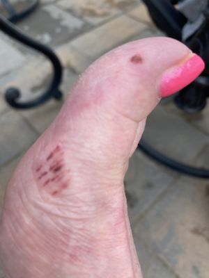 Thus is my foot after my pedicure on July 13th