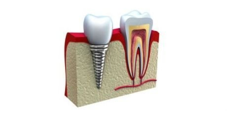 Missing tooth replaced with an implant.