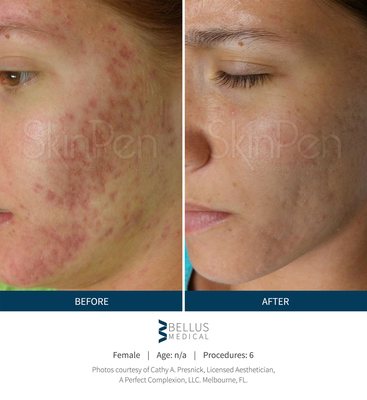 SkinPen is effective at improving acne scarring.