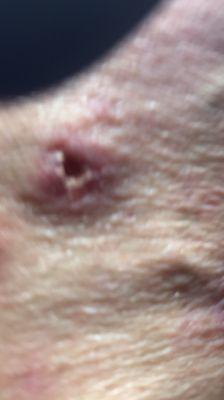 Close-up of scabies burrow. I have these all over my body.