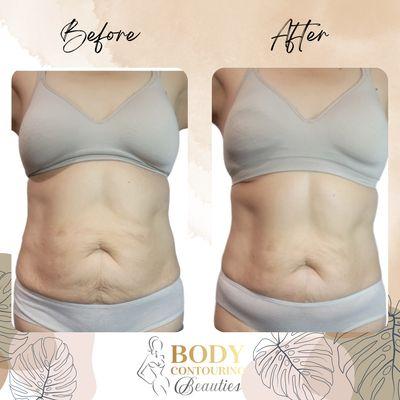 Do you have some extra fat and lise skin? Services include Ultrasonic Cavitation 
Wood therapy  and radio frequency skin tightening.