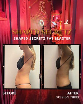 Body Sculpting Treatment - Before and After