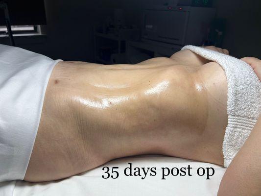 Lipo 360 by Dr Larry Fan