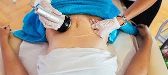 Laser Lipo Cavitation (not surgery)