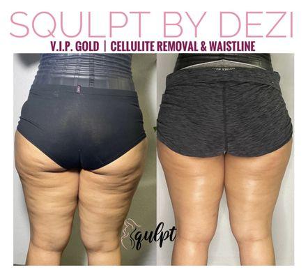 Cellulite treatment and smaller waistline. Client is extremely happy with the results.