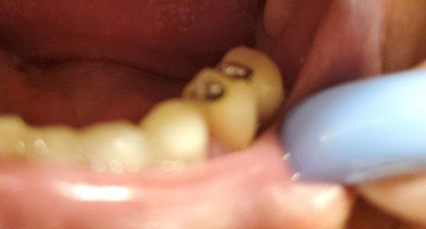 My two porcelain crowns that this 'doctor' put in and then ground down to make them fit.