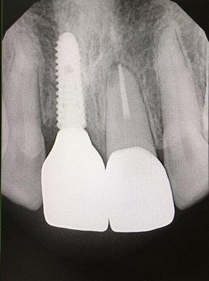 Completed RCT and zirconia crowns placed.