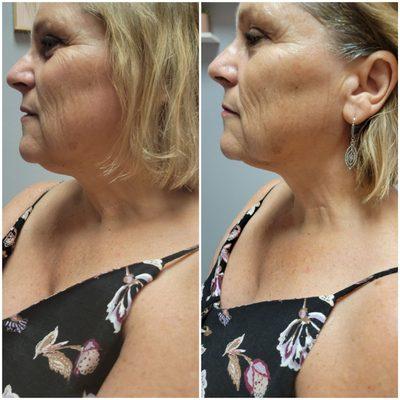 Befor and After: 1st session of Non-invasive Skin Tightening to face, under chin, and neck.