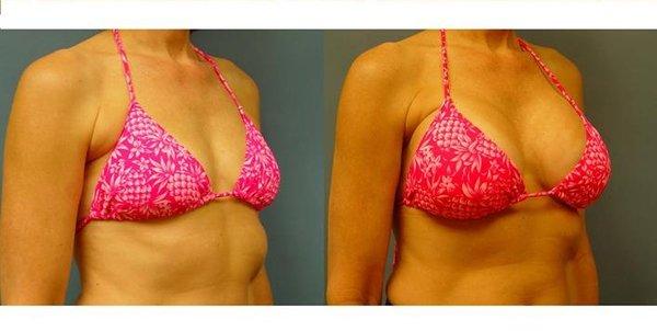 Breast Augmentation before and after photo