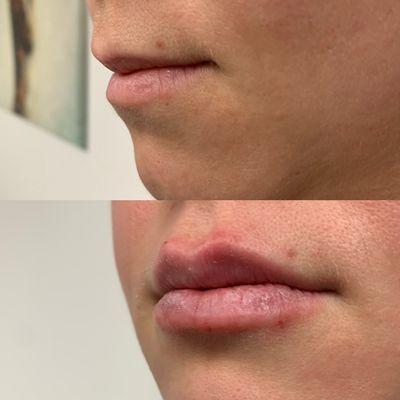 This client in her 30's wanted more projection of her upper lip along with lower volumization. .85ml of Versa used to achieve these results.