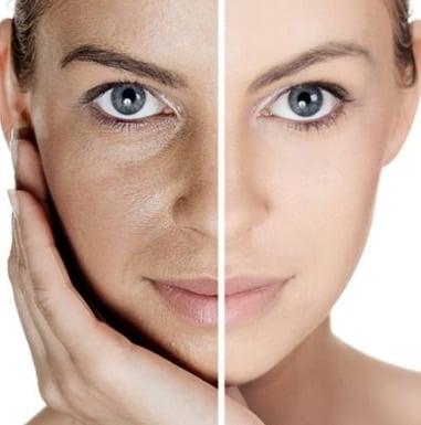 To create major changes in the skin, I recommend a chemical peel. Correct hyperpigmentation, fine lines, wrinkles, and texture issues.