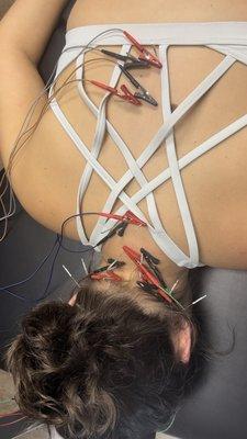 Functional Dry Needling with E-Stim at Pinecone Physio in Reno, NV.