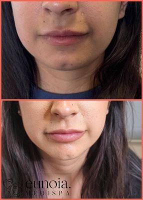 Notice any hearts? With a little chin enhancement with Botox you can achieve that heart shaped contour look. Only at Eunoia