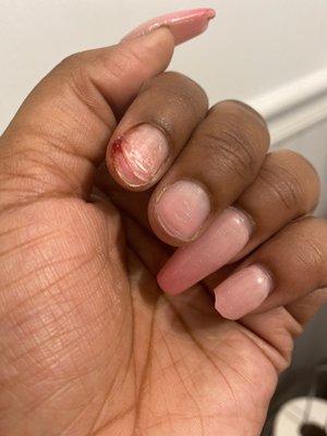 My natural nail is peeled off of ring finger.