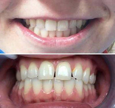 This case was completed in only 6 months using clear braces to address some uneven spacing.