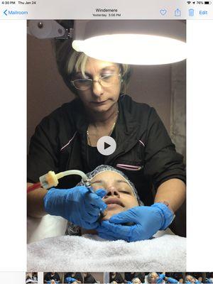 Microdermabrasion