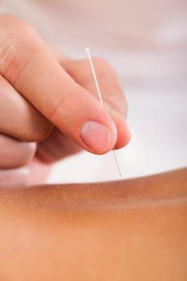 Acupuncture can be used in conjunction with other modalities, or as a stand-alone therapy to relax the mind, release trigger ...