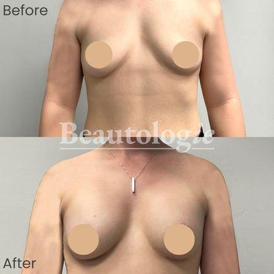 Bilateral Breast Augmentation with 350ml Saline Implants Before and After