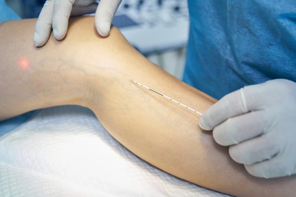 EVLT Endovenous laser treatment