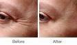 Botox...Great for Crows Feet, Between Eyebrows and Forehead!...A must have! Typically lasts 3-4 months.