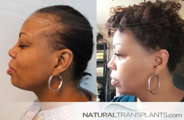 Can Traction Alopecia Be Reversed