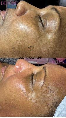 Procell Therapy Microchanneling Before & After Results

Instagram: @skinxscape