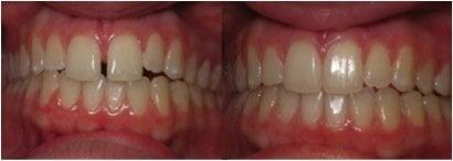 Invisalign done at Creekview Dental