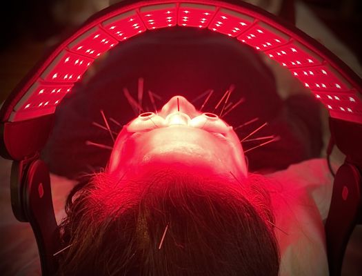 Facial Acupuncture before microneedling procedure.