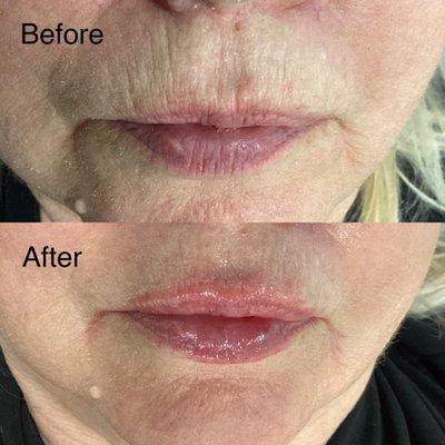 Dermal filler Lips 
Before and After