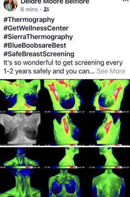 My breast Thermography 2019. I will put frankincense and lavender and do lymph massage on the left red spot.