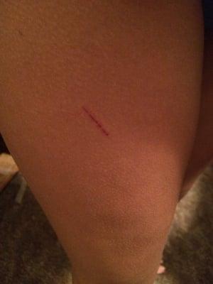 The scratch on my leg due to the employees mistake .