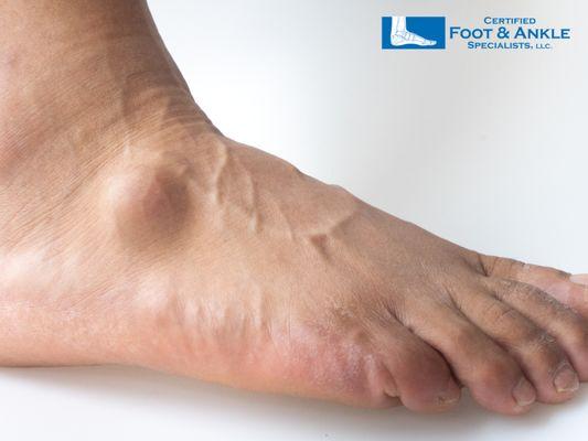 A lump on top of the foot