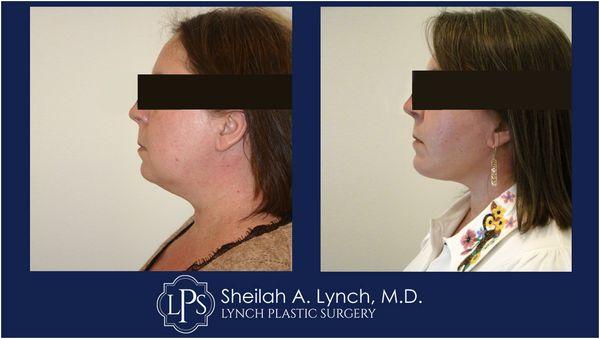 Neck Lift (side ) Before & After Patient Receive an expert opinion from Board Certified Plastic Surgeon  Dr. Sheilah A. Lynch.