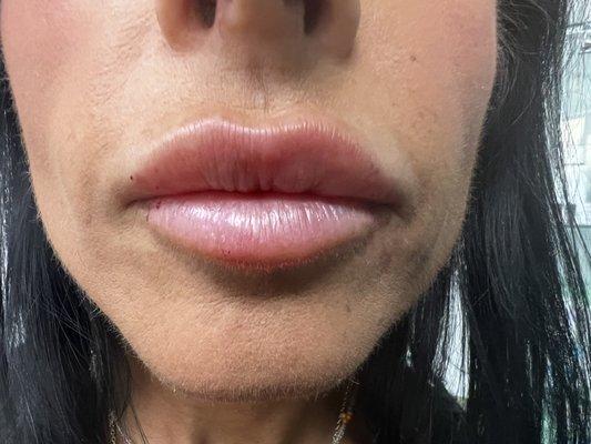 The lip filler is just perfect, not too much. The injector was carful not to bruise me. My girlfriend's complement me all the time.