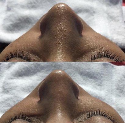 Clogged pores gone after our Delux Hydrafacial