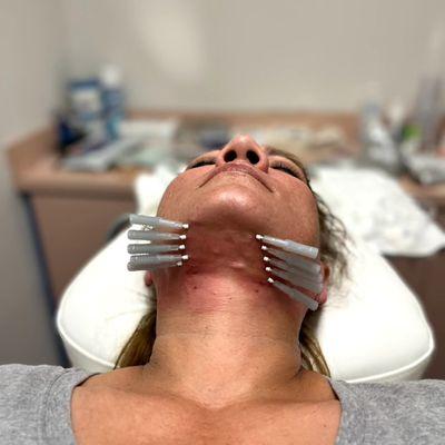 Aestheta - Ascending Thread Face Lift