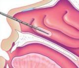 Turbinate reduction can help to open your airway.