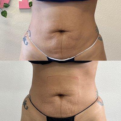 Noninvasive tummy Contouring!