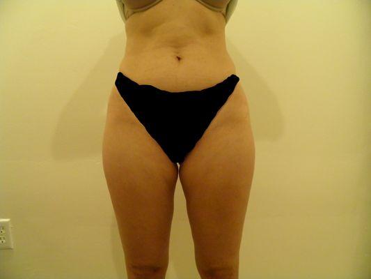 Thighs after Smart Lipo