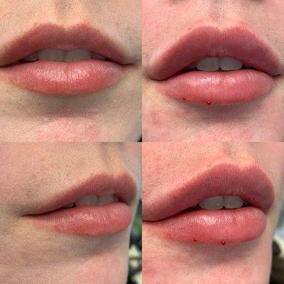 Lip augmentation