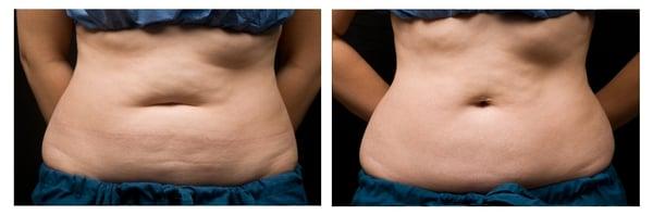 Before and after 3 months after one CoolSculpting procedure.