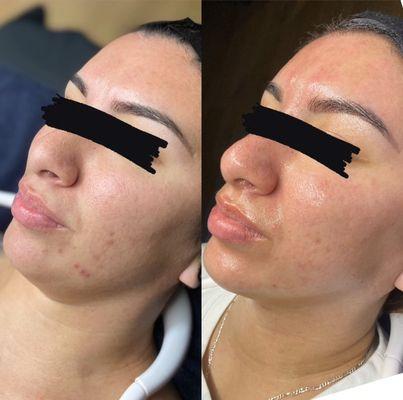 Chemical Peel treatments (4 treatments completed)