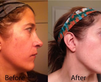 Before and after of IPL laser on my cheek to reduce the hyper-pigmentation.